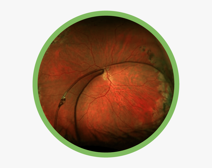 Complex Anterior Segment Disease - Icon Esports, HD Png Download