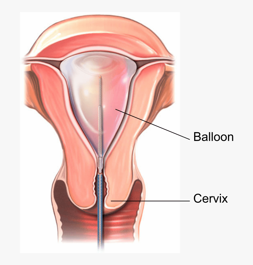 Illustration Showing A Thermal Balloon Endometrial - Uterine Ablation, HD Png Download