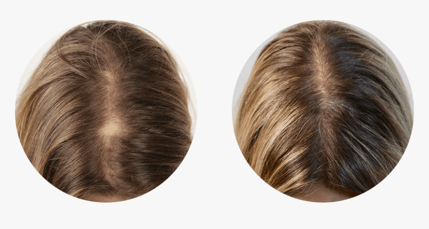 Nutrafol Before After, HD Png Download