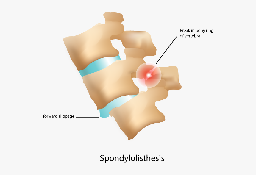 Vertebrae Out Of Place, HD Png Download