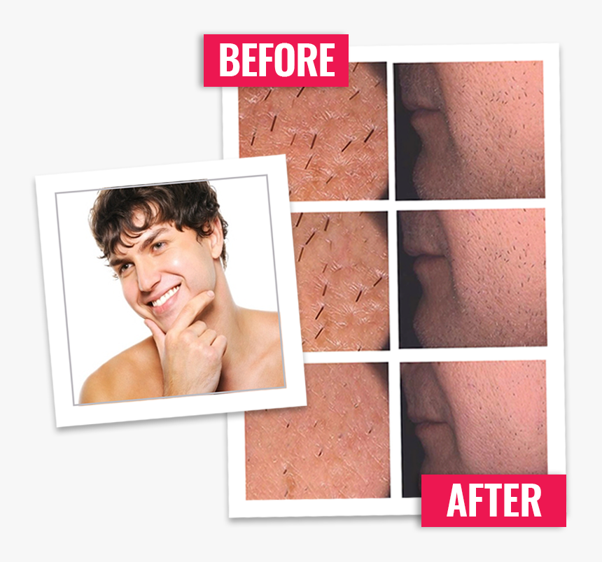 Beard Removal, HD Png Download