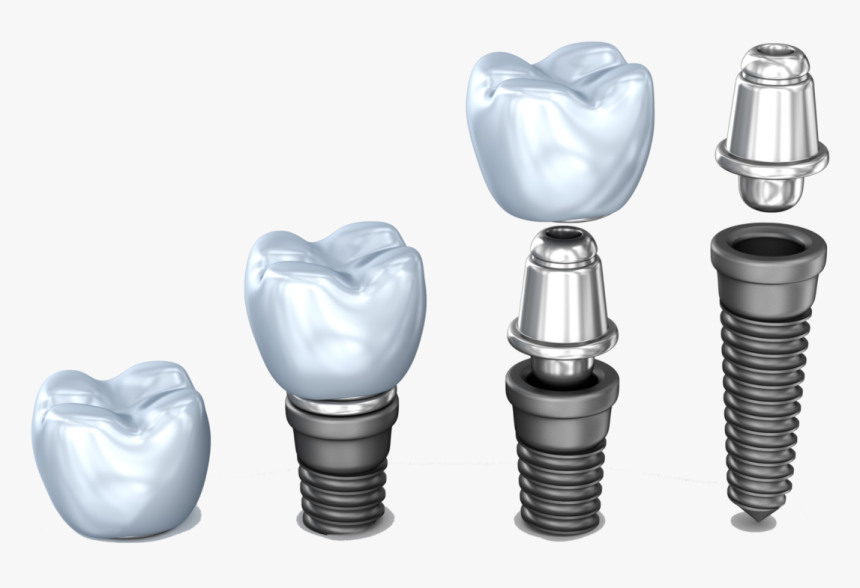 Implant Pieces Dental Implant Dentist Northborough - Implante Dental De Titanio, HD Png Download