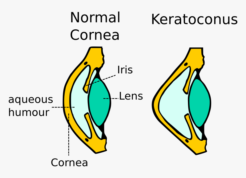 Kerataconus Image - Diagram Of Keratoconus, HD Png Download