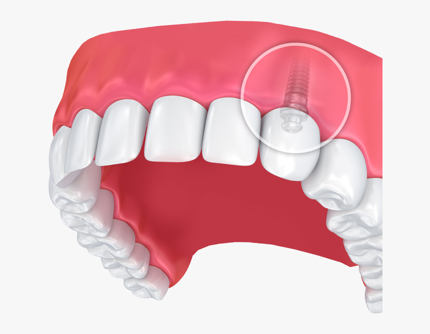 Upper Dental Arch With Zoomed In Internal View Of Dental, HD Png