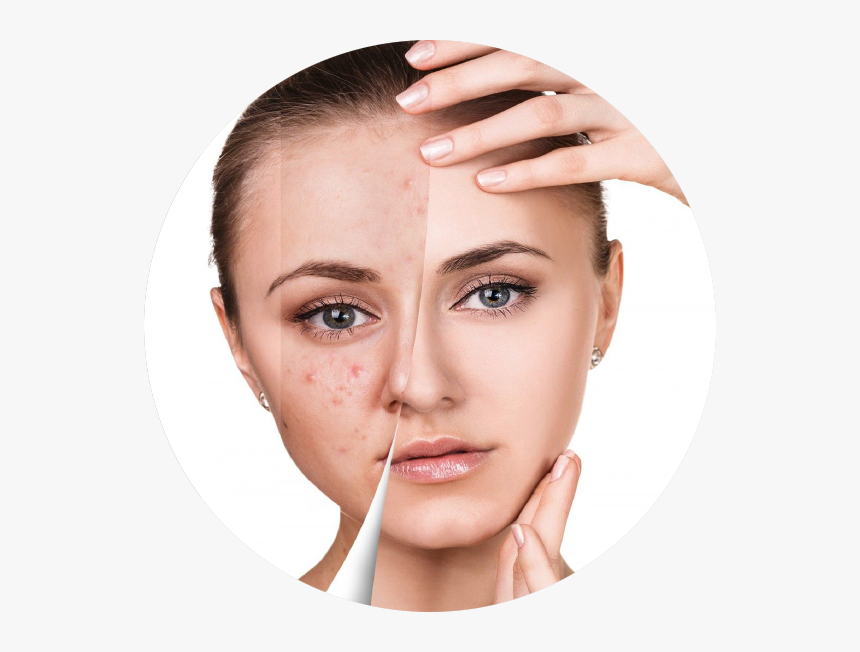 Beauty Face Before And After, HD Png Download