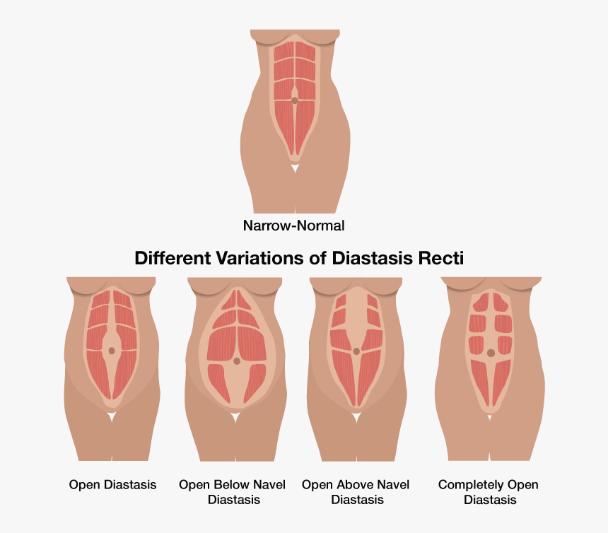 What Is Diastasis Recti - Diastasis Recti Types, HD Png Download