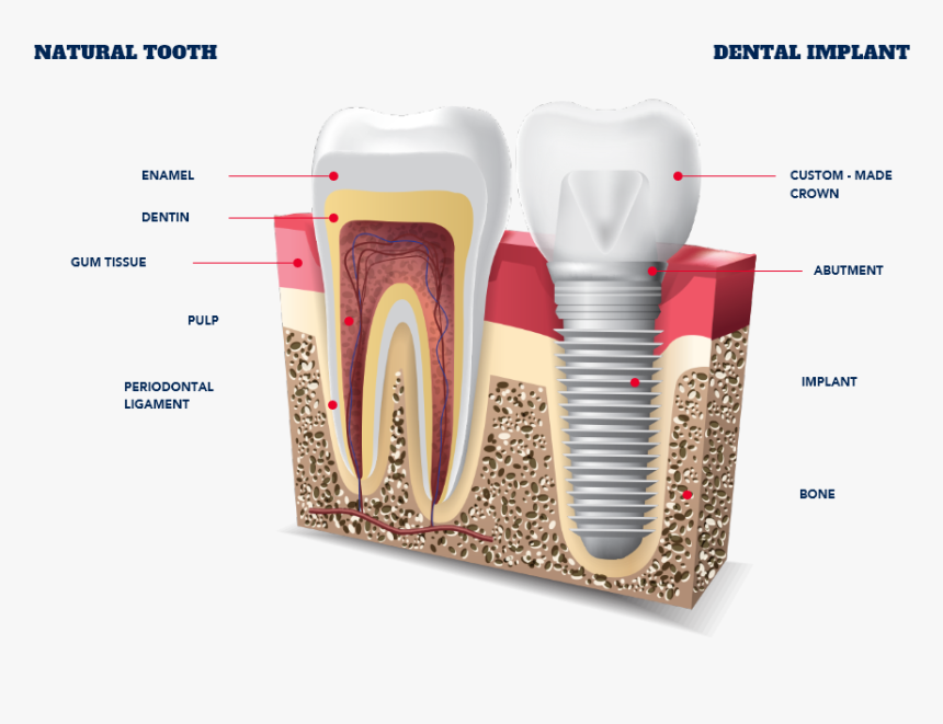 Tooth Implant, HD Png Download