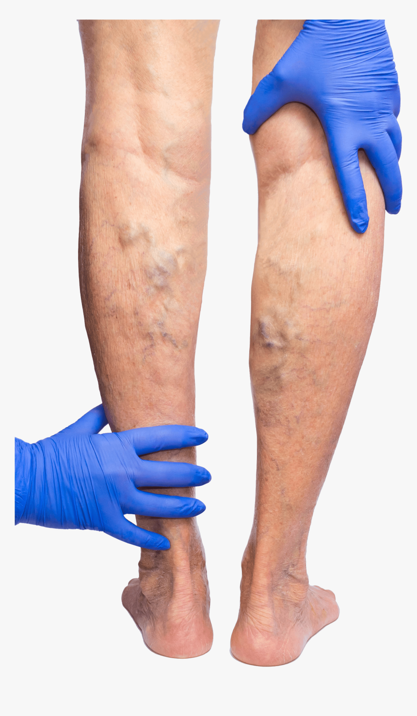 Gloved Hands Feeling The Backs Of Legs That Are Covered - Phlebitis Varicose Veins, HD Png Download