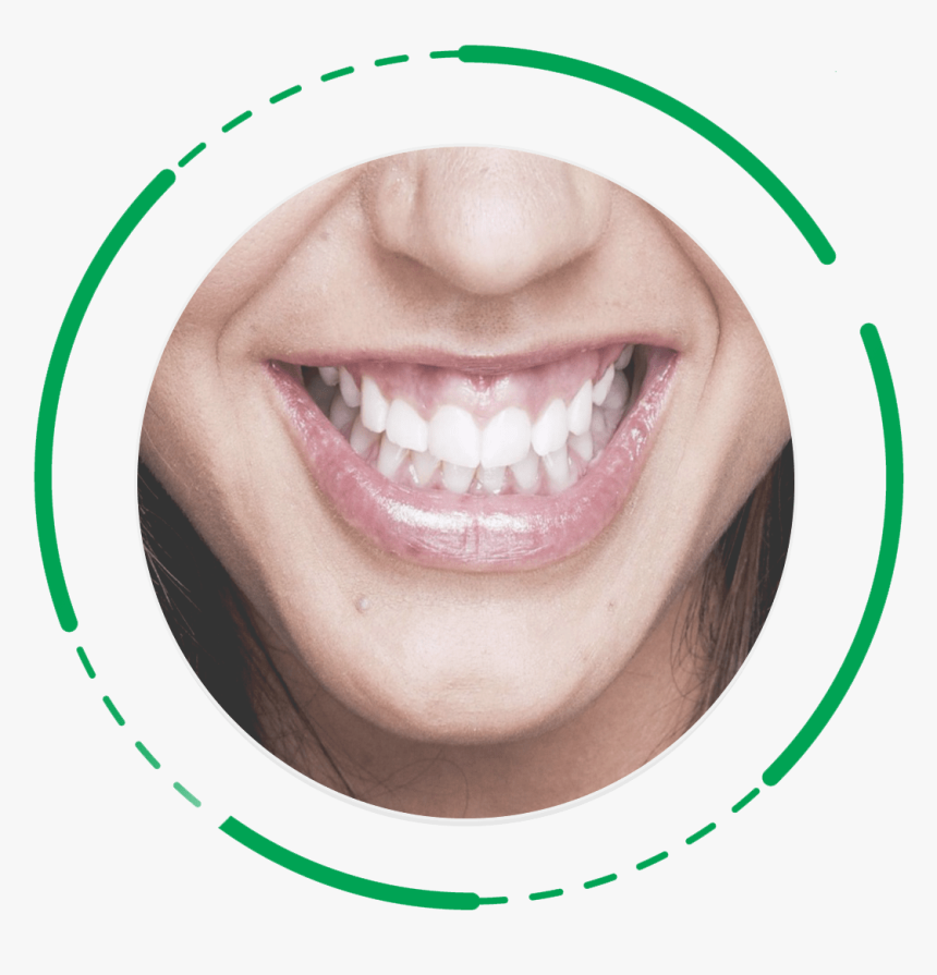 Gummy-smile - Gummy Smile, HD Png Download