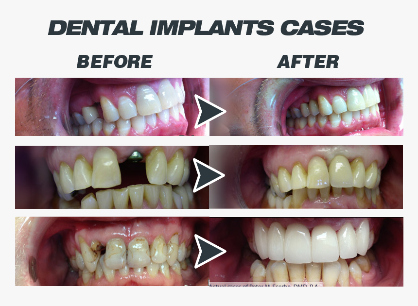 Tooth Bleaching, HD Png Download