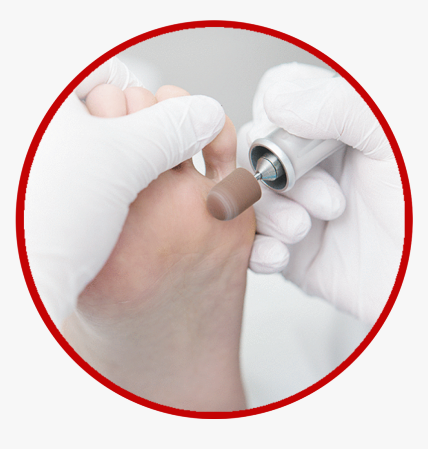 Calluses Png - Instituto De Podologia Goiania, Transparent Png