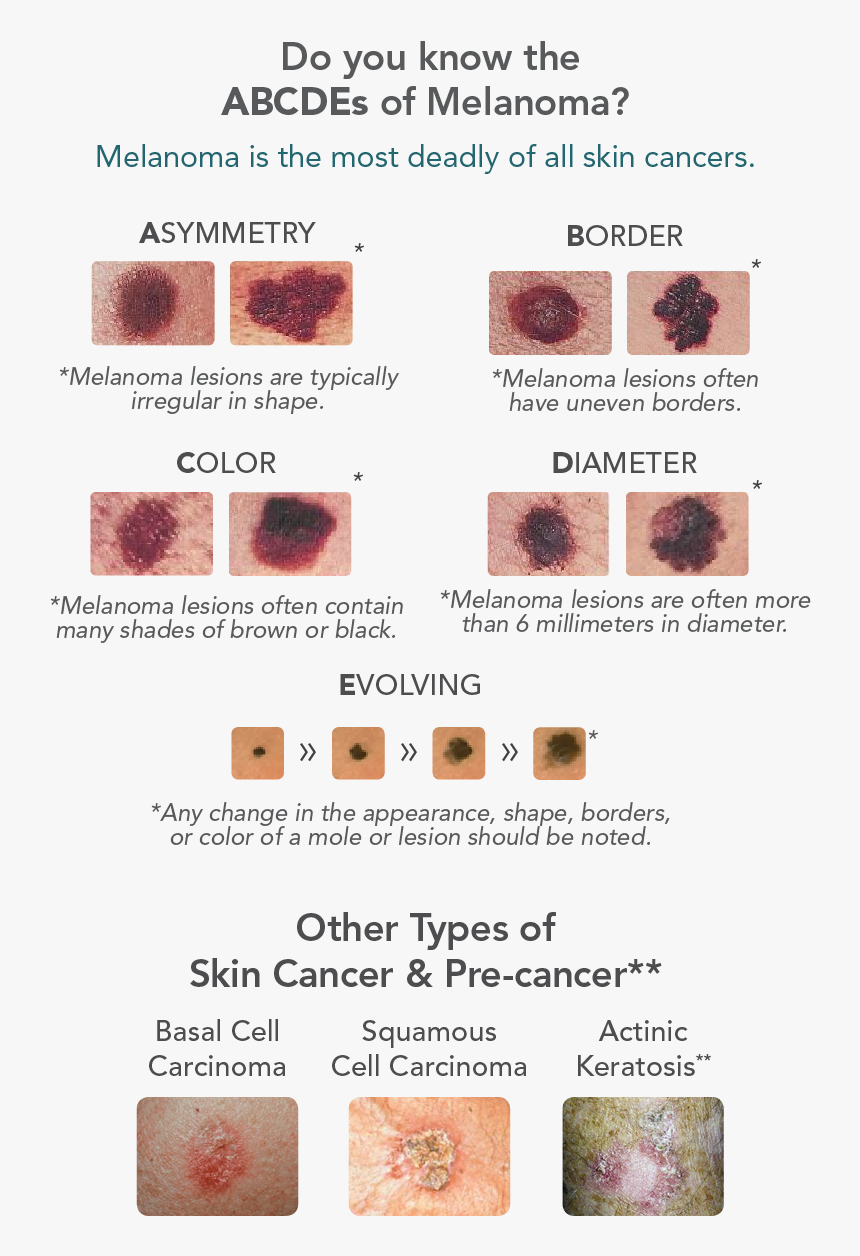 Skin Cancer Warning Signs, HD Png Download