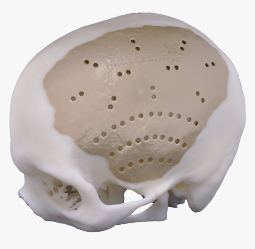 Peek Cranial Implant, HD Png Download