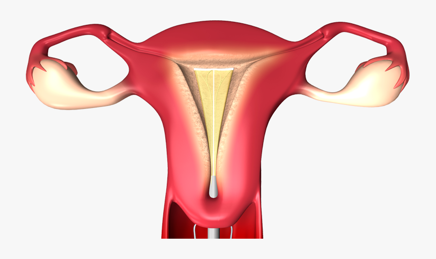 Endometrial Ablation, HD Png Download