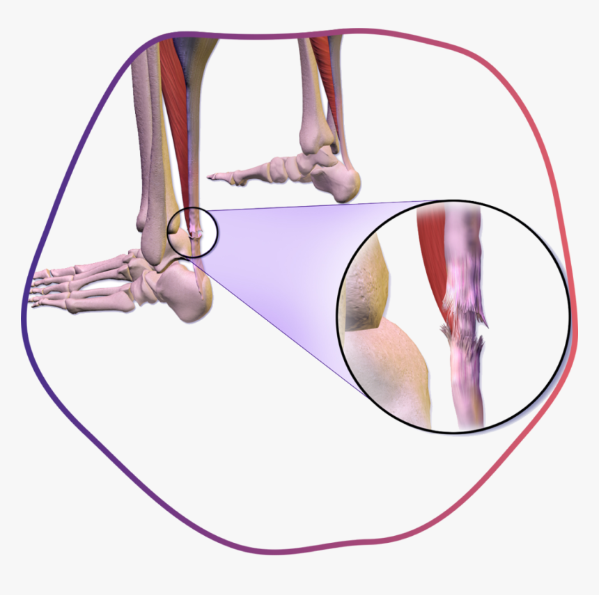 Achilles Tendon Injecting Plasma, HD Png Download