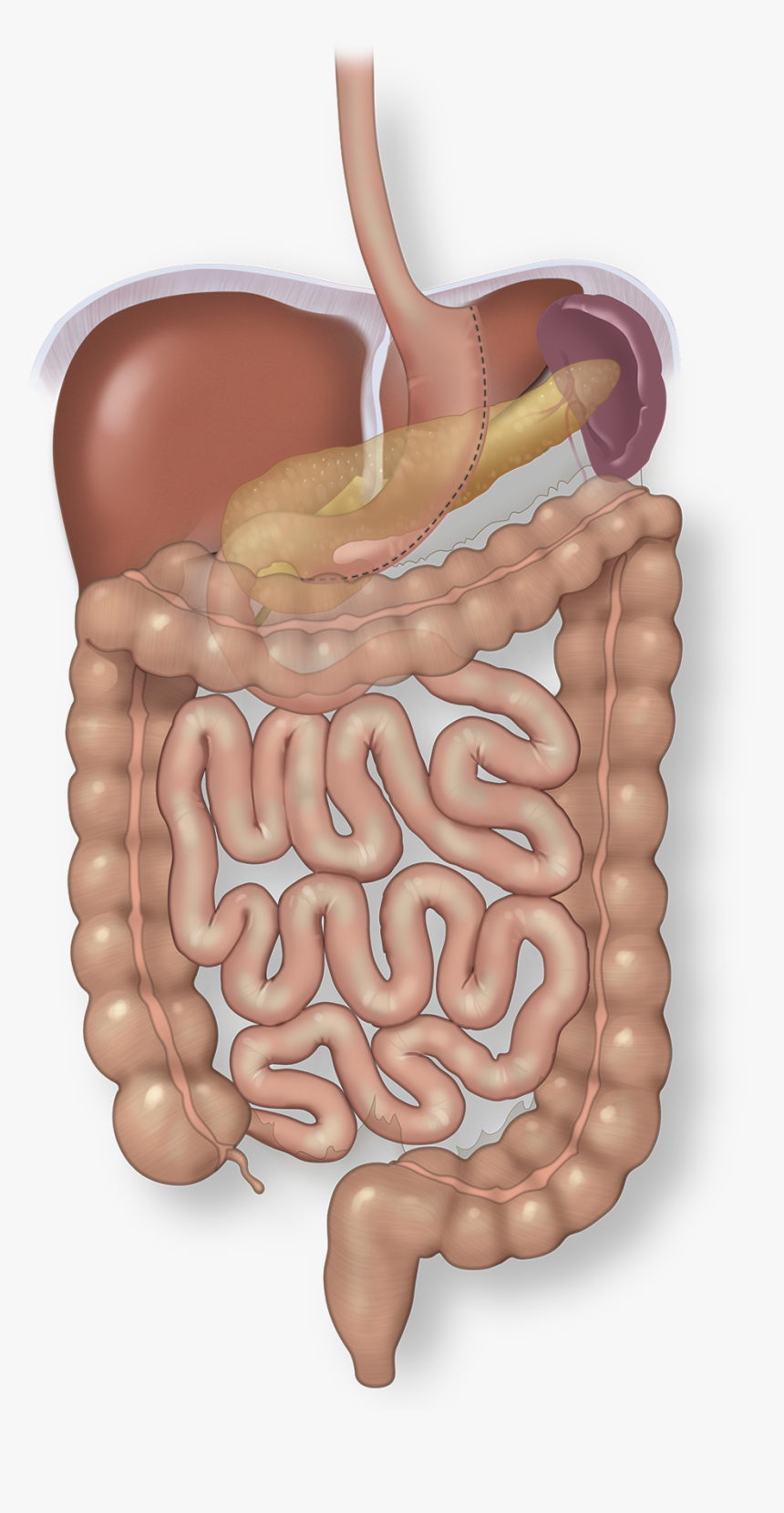 Direct Hernia Demonstrated Medial To Epigastric Vessels - Illustration, HD Png Download