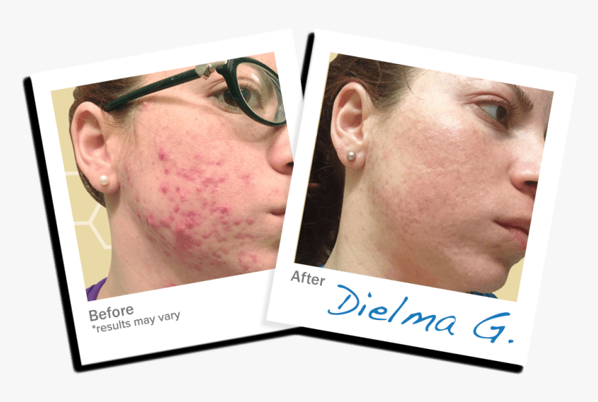 Dielma Acne Trial - Crew Cut, HD Png Download