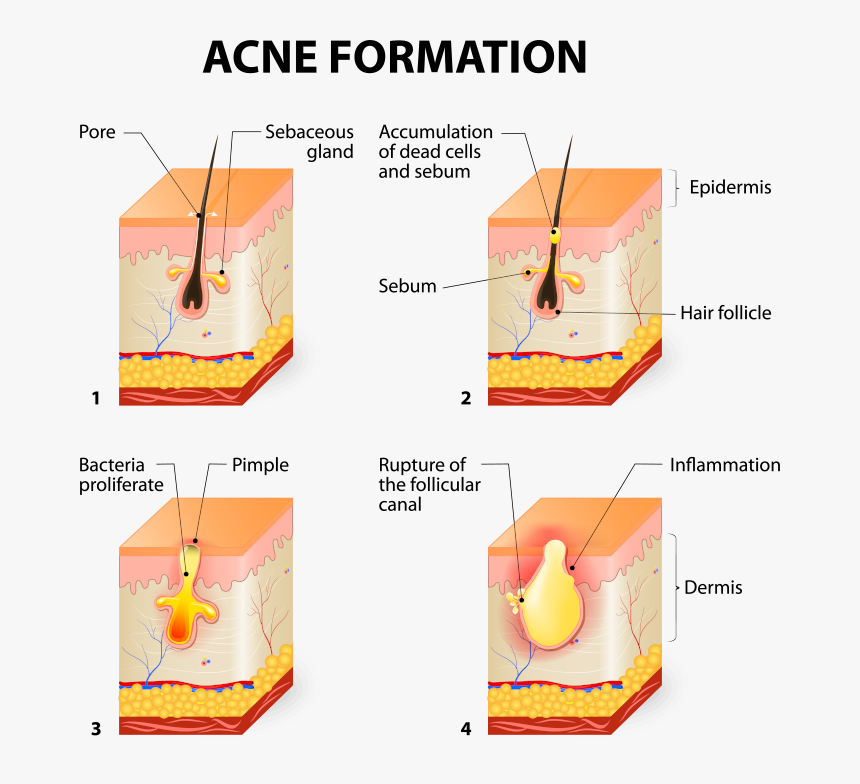 Acne Formation, HD Png Download