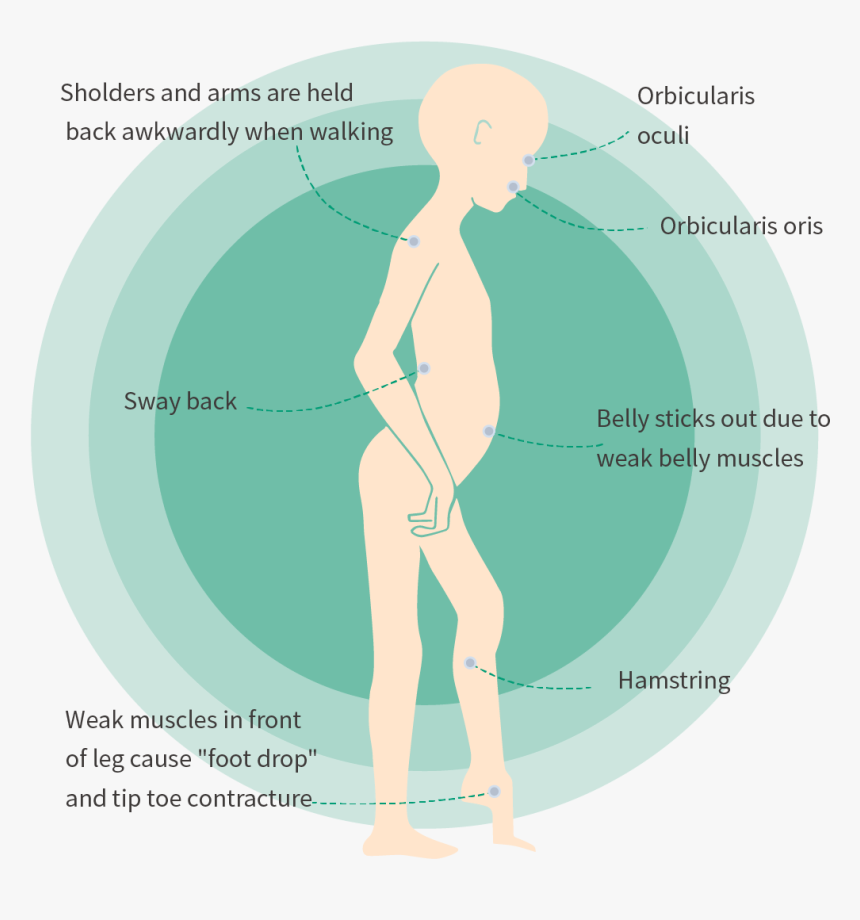Muscles Affected By Fshd, HD Png Download