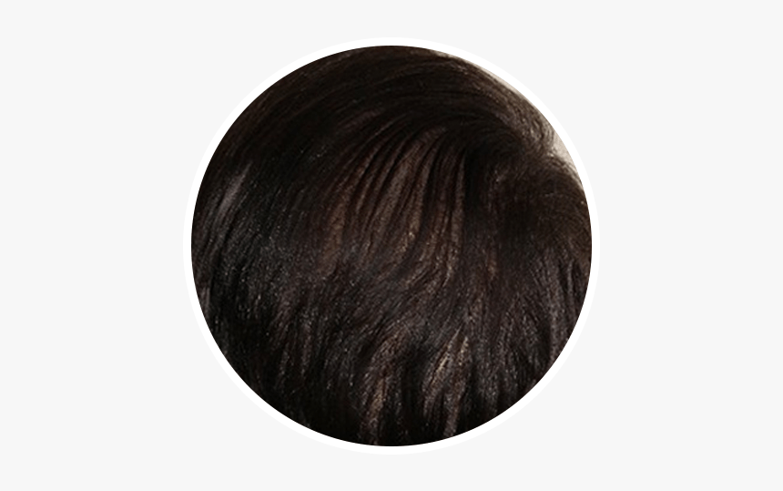 After Hair Restoration In A Circular Picture - Blond, HD Png Download