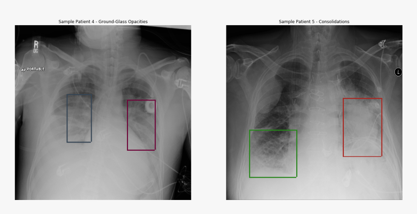 Pneumonia Detection, HD Png Download