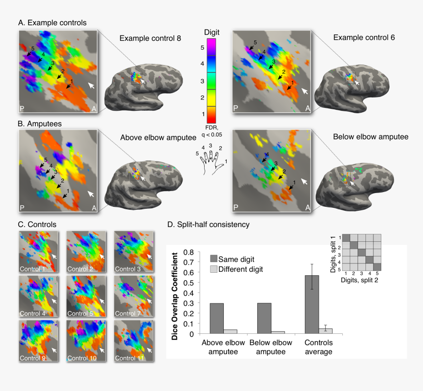[img] - Pet Scan Of Phantom Pain, HD Png Download