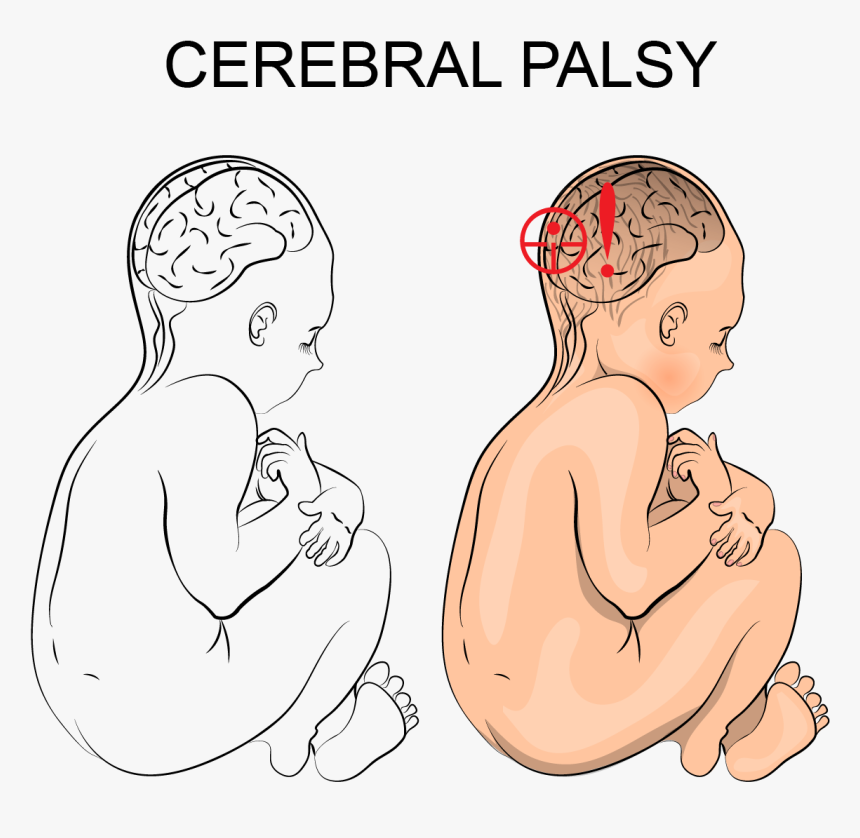 How Can I Tell If My Child Has Cerebral Palsy - Cerebral Palsy Illustration, HD Png Download