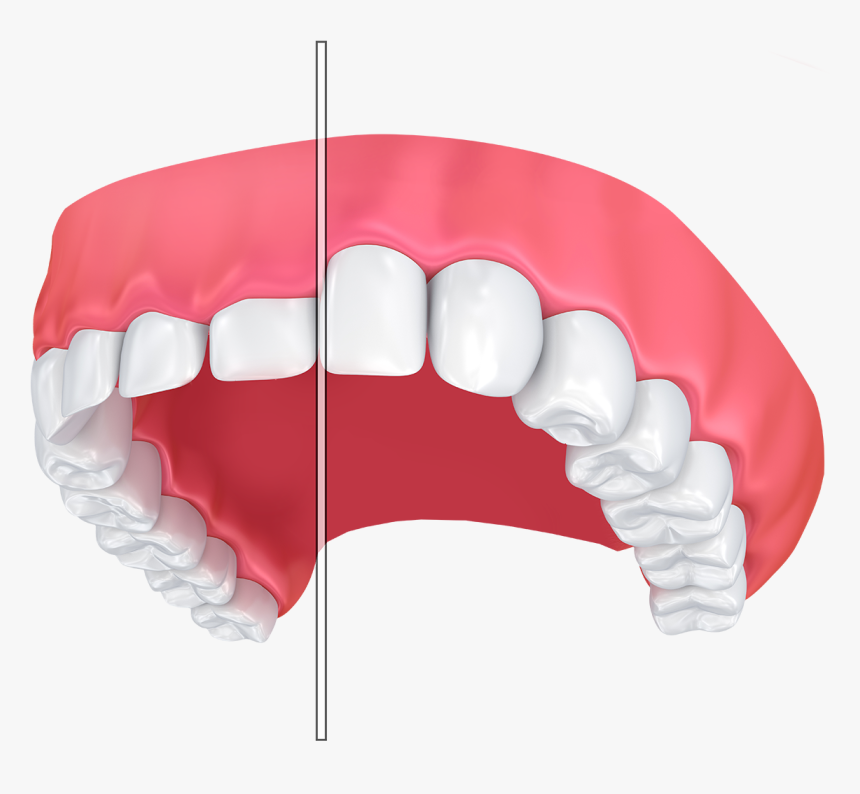 An Illustration Of Before And After Laser Gum Contouring - Estetik Dolgu, HD Png Download