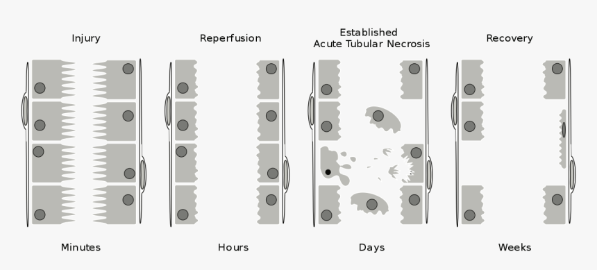 Acute Kidney Injury, HD Png Download