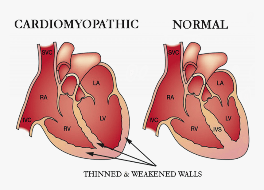 Cardiomyopathy Heart, HD Png Download