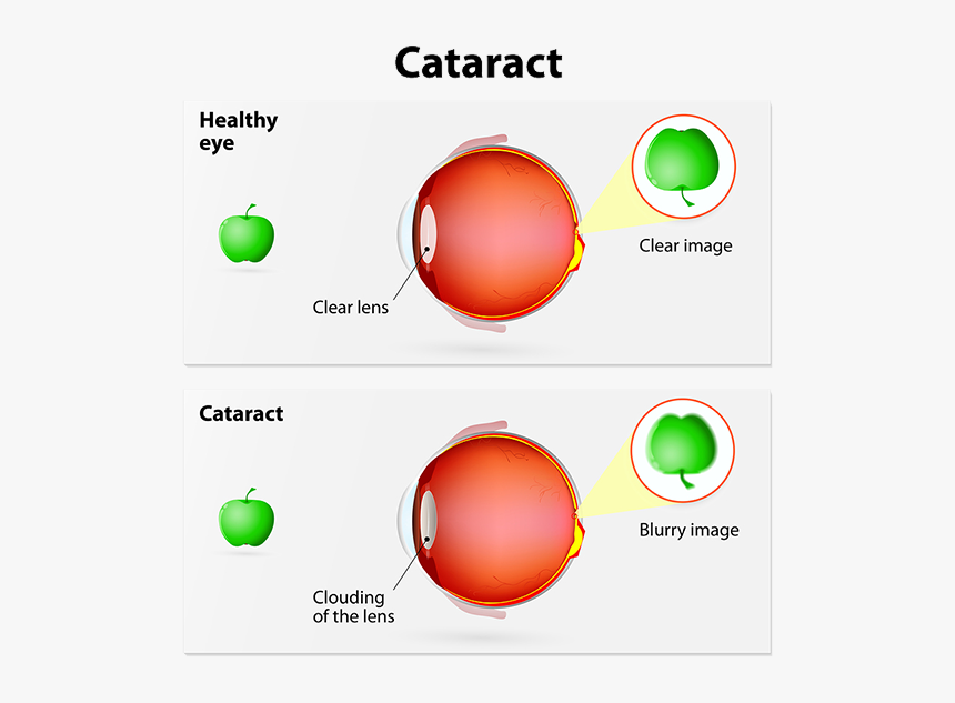 Cataract - Cataract Ray Diagrams, HD Png Download