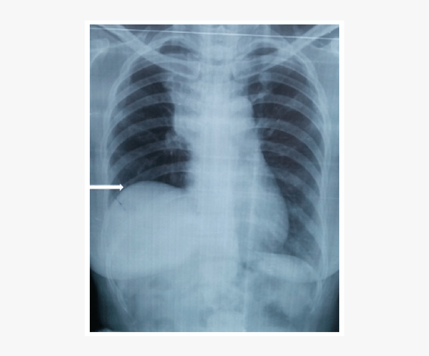 Elevated Right Hemidiaphragm X Ray, HD Png Download