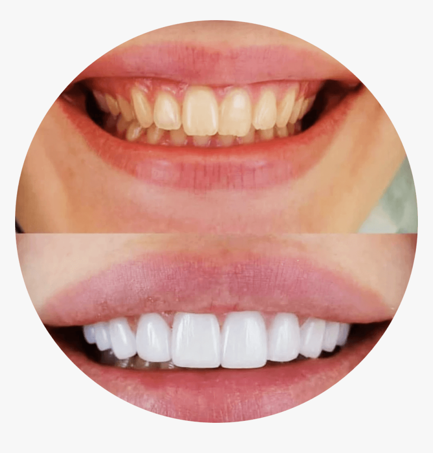 Veneer, HD Png Download