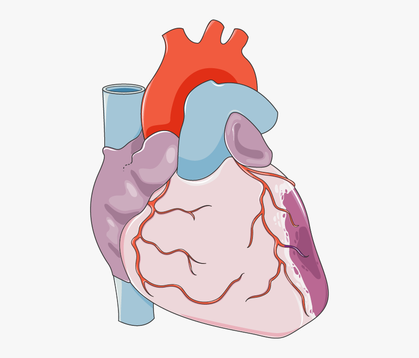 Remote Ischemic Preconditioning, HD Png Download