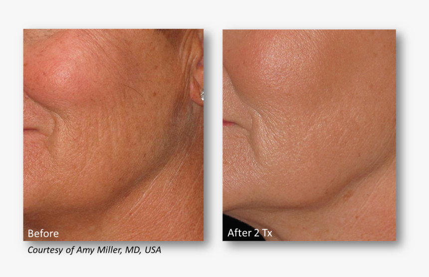 Lutronic Genius Rf Microneedling, HD Png Download