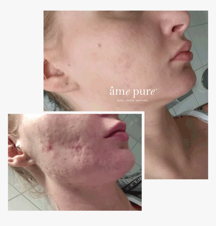 Ame Pure Before And After, HD Png Download