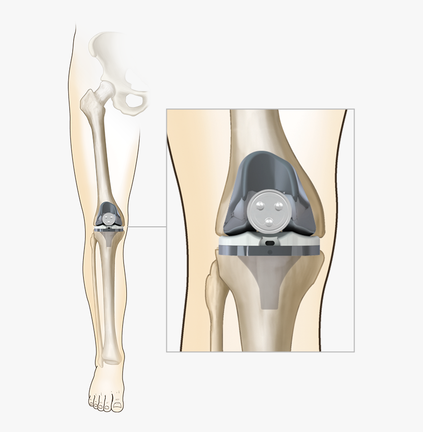 Total Knee Replacement Femur, HD Png Download
