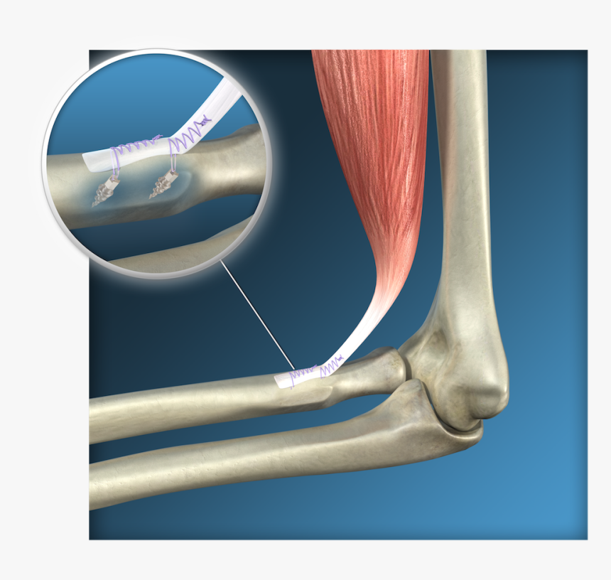 Endoscopic Distal Biceps Reinsertion Surgery, Toulouse - Ruptura Distal Del Biceps, HD Png Download