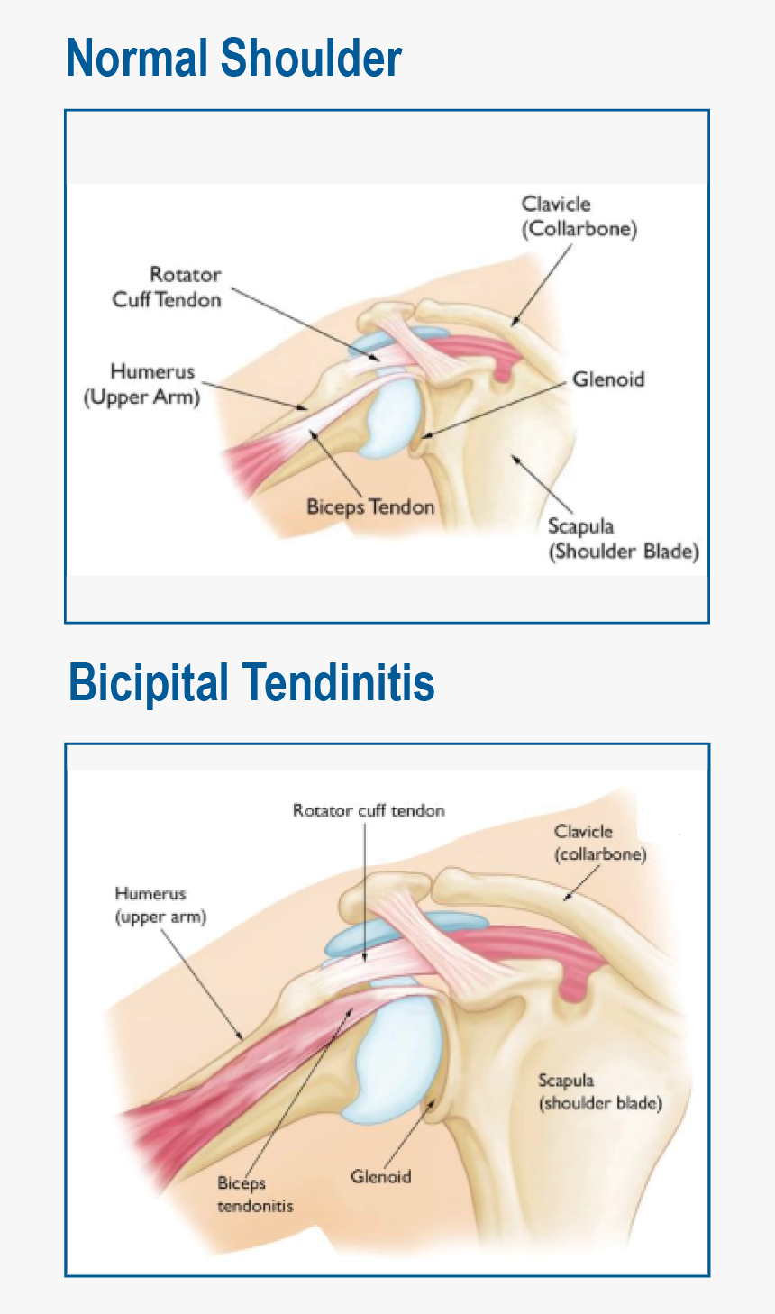 Shoulder Tendonitis Diagram, HD Png Download