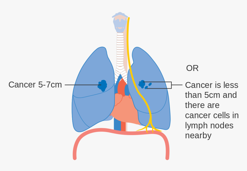 Stage 1 Early Stage Lung Cancer, HD Png Download