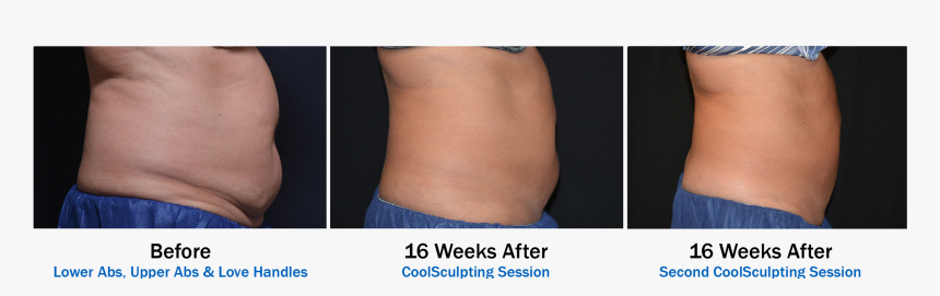 Coolsculpting Orlando, HD Png Download