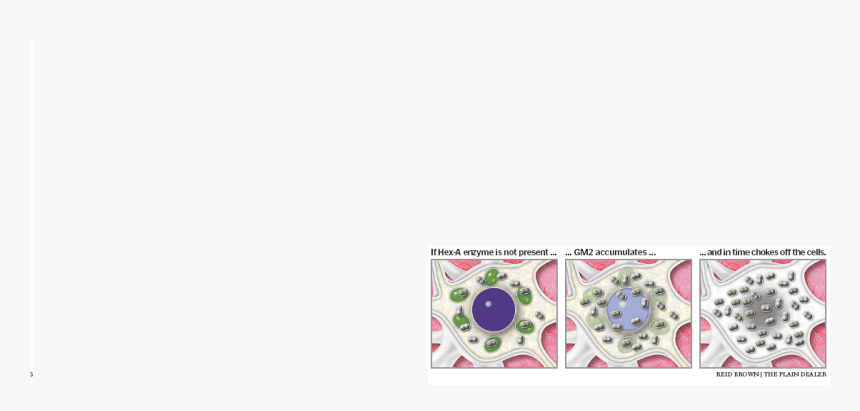 Cell, Disease, En, Nerve, Sachs , Png Download - Tay Sachs Disease, Transparent Png