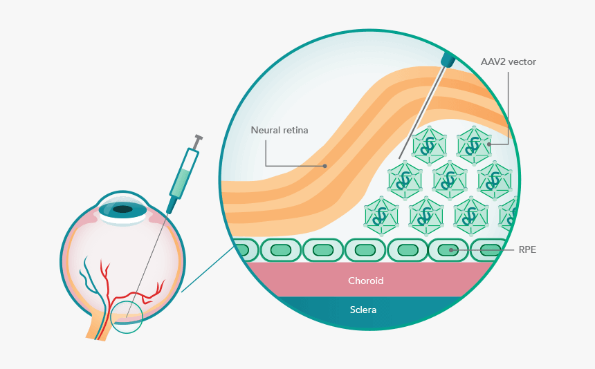 Illustration Of The Rpe65 Gene Delivery Method - Luxturna Mechanism Of Action, HD Png Download