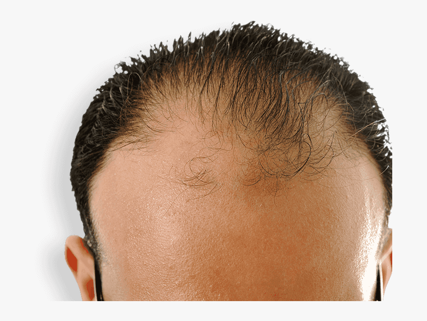 Receding Hairline - Will Castor Oil Regrow Hair, HD Png Download