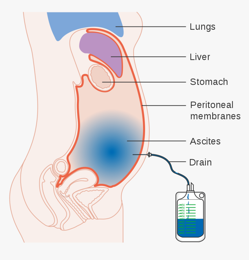 Diagram Of Ascites, HD Png Download