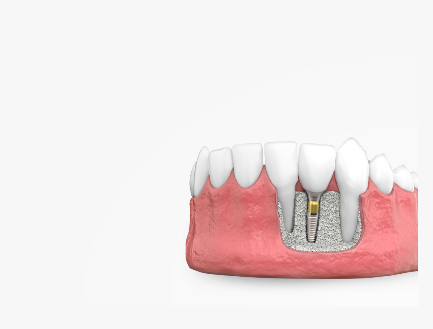 Dental Implants - Marking Tools, HD Png Download