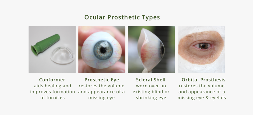 Ocular Prosthesis Types Diagram - Types Of Eye Prosthesis, HD Png Download