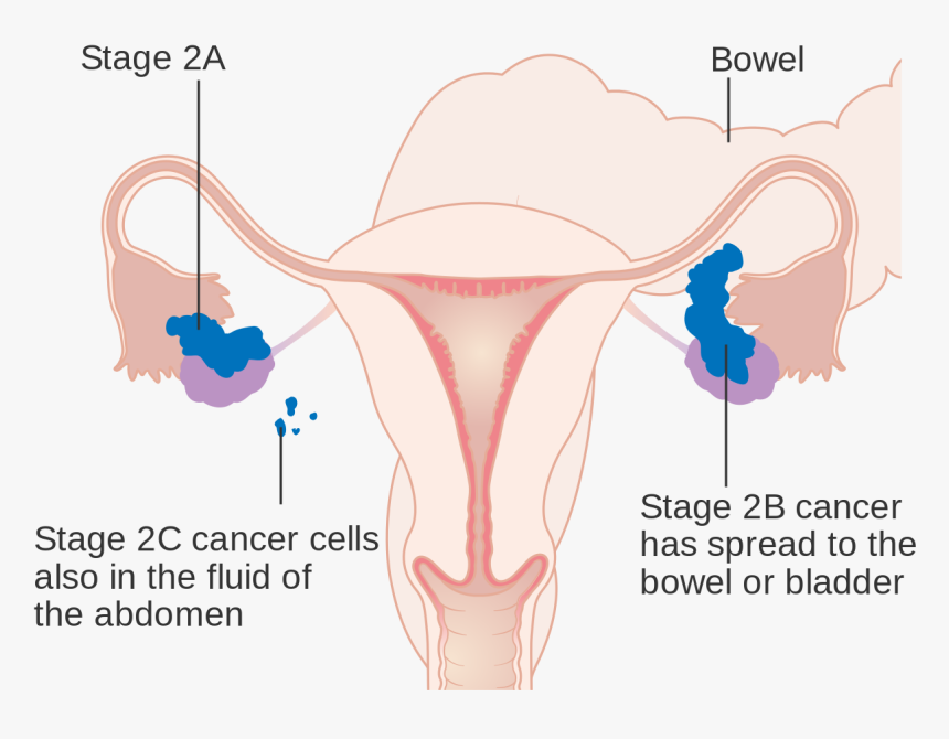 Stage 1 Ovarian Cancer Staging, HD Png Download