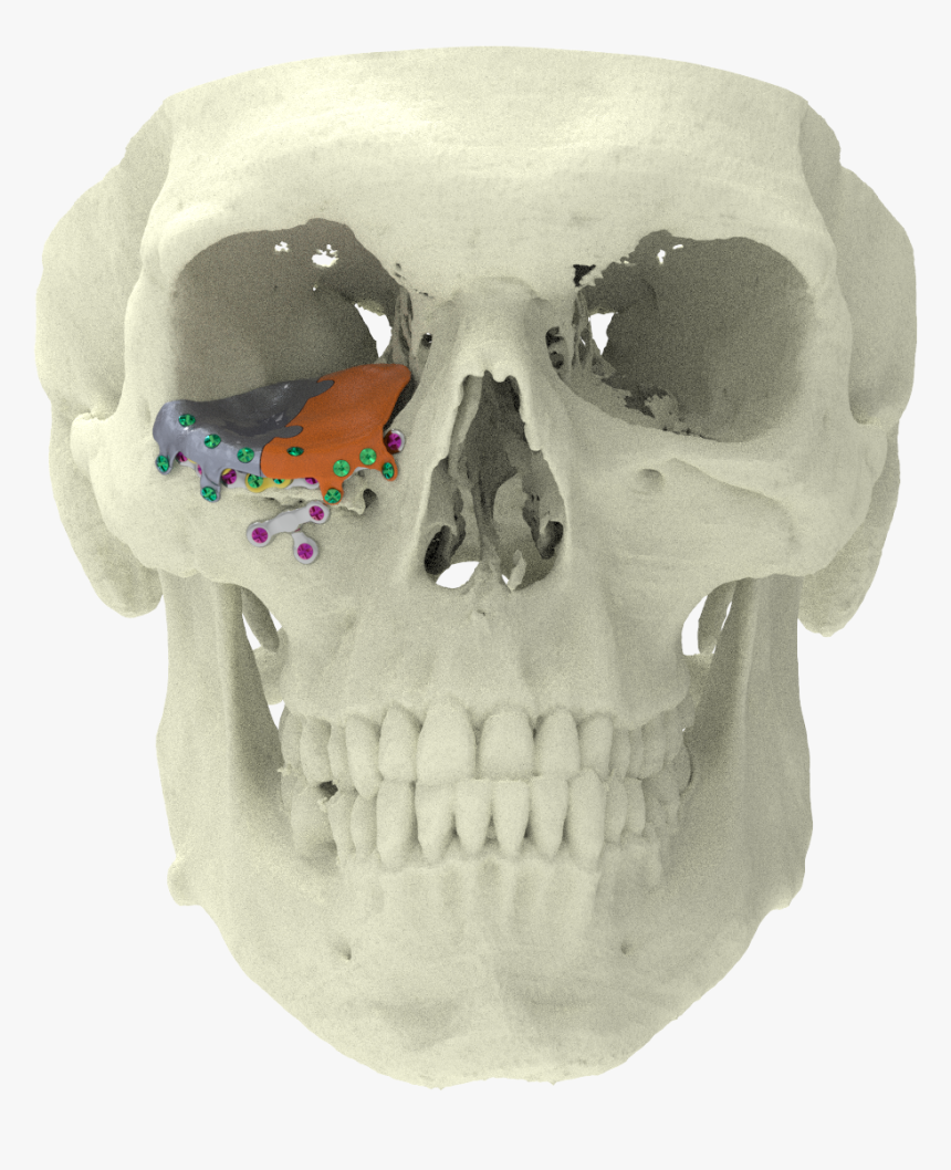 Xilloc Medical B - 3d Printed Titanium Plate For Zygomatic Fracture, HD Png Download