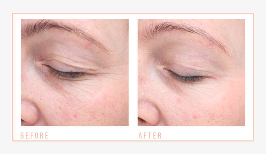 Before & After Hooded Eyes 2 - Collage, HD Png Download